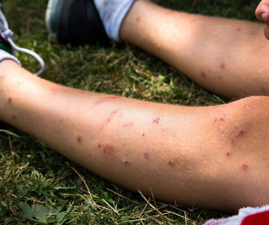 Young boy with mosquito bites all over his legs.